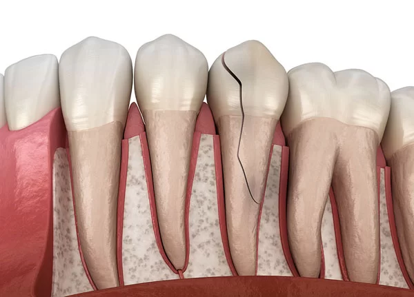 tooth fractures or tooth cracks