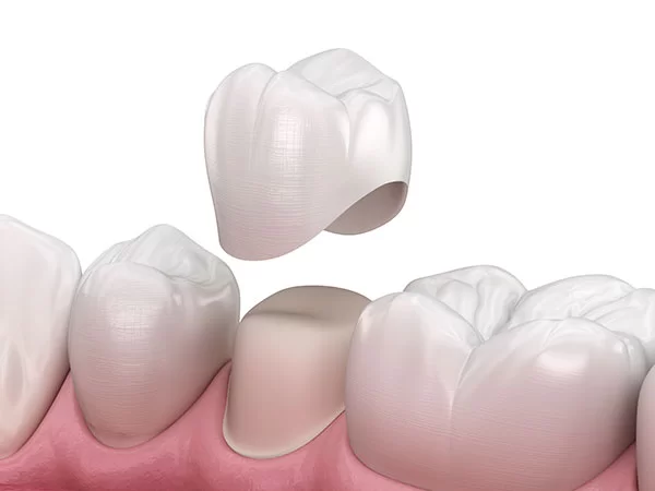 dental crowns