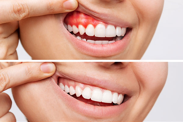 treated gum disease