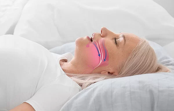 obstructive sleep apnea (OSA)